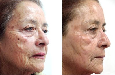 Laser Skin Resurfacing Results