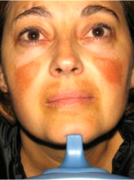 Laser Pigmentation Removal Results