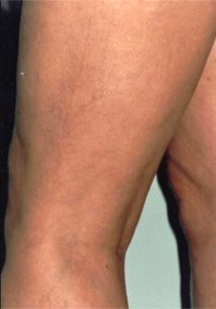 Varicose and Spider Vein Removal Results