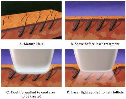 Laser Hair Removal Treatment